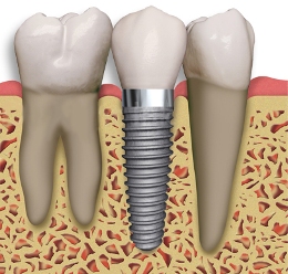 Tulsa Dental Implants