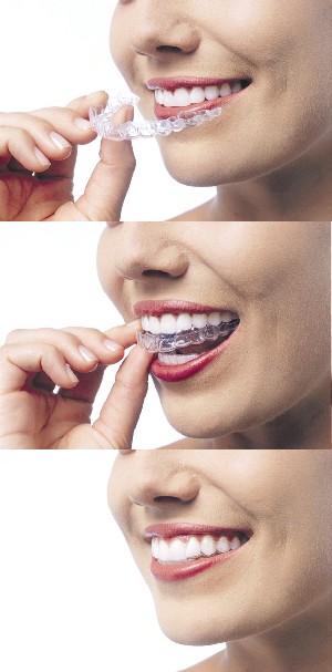 Cha Tulsa Invisalign