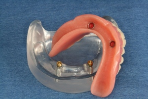 Tulsa Affordable Snap On Dentures