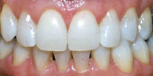 After teeth whitening