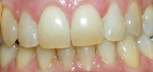 Before Teeth Whitening