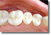 Tulsa Mercury free Fillings