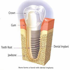 Dental implant