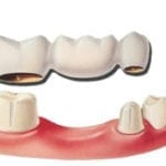 Tulsa Dental Bridge
