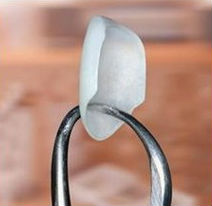 Tulsa Porcelain Veneers
