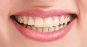 before teeth whitening