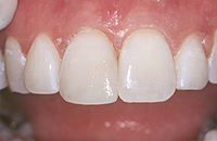 A smile after a chipped tooth is repaired