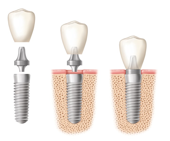 Illustration of dental implants in three parts