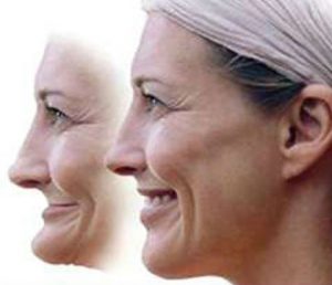 An image of a woman before and after facial collapse