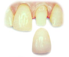 Image of a crown being placed on a tooth