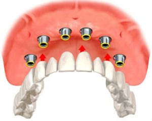 implant overdentures