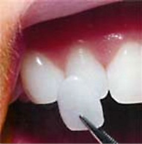 A porcelain veneer being placed on a tooth