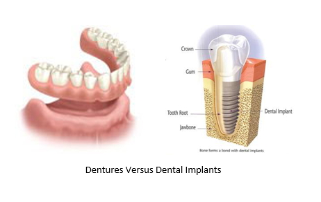 illustration of dentures beside a dental implant