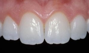 Close up image of teeth.