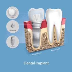 dental implant beside a natural tooth