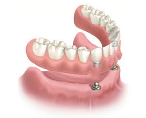 Diagram of a snap-on denture from Tulsa, OK dentist Jerome Cha, DDS