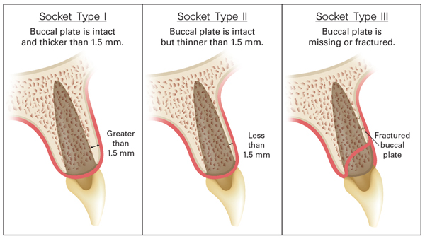 Diagram of buccal bone plate with three types of thickness from 1.5 mm and below