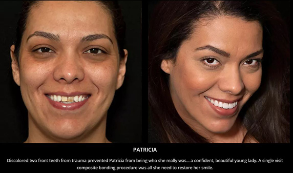 Before and after dental bonding photos from Tulsa cosmetic dentist Dr. Cha