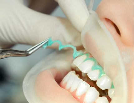 Lips retracted and teeth gums coated before teeth whitening