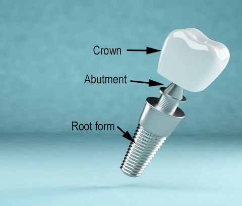 A dental implant model with crown, abutment, and root form labeled, for information on sinus agumentation
